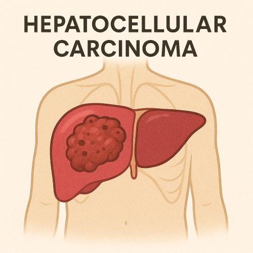 Hepatocellular Carcinoma